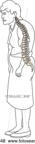 Illustration of elderly woman with misshapen spinal column as a result of osteoporosis. View Large Illustration Stock Illustration - Illustration of elderly woman with misshapen spinal column as a result of osteoporosis.. Fotosearch