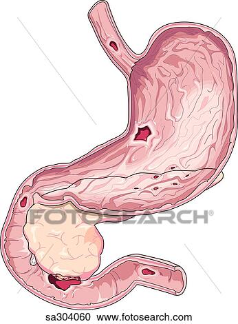 Image showing a frontal view of a stomach with several ulcers. View Large Illustration Clipart - Image showing a frontal view of a stomach with several ulcers.. Fotosearch