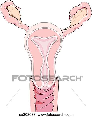 Image showing highlighted uterus which is removed during a hysterectomy. View Large Illustration Drawing - Image showing highlighted uterus which is removed during a hysterectomy.. Fotosearch