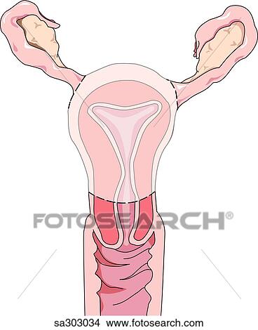 Stock Illustration - Image showing highlighted uterus which is removed during a hysterectomy.. Fotosearch