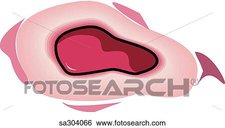 Jejunum ulcer. View Large Illustration Stock Illustration - Jejunum ulcer.. Fotosearch