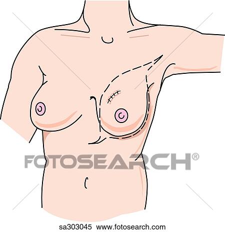 Mastectomy, step 1. View Large Illustration Stock Illustration - Mastectomy, step 1.. Fotosearch