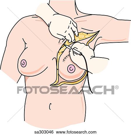 Stock Illustration - Mastectomy, step 2.. Fotosearch