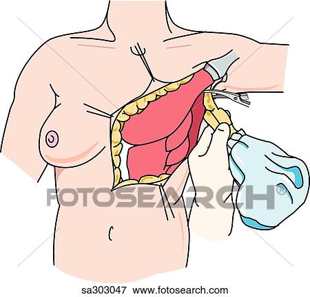 Mastectomy, step 3. View Large Illustration Stock Illustration - Mastectomy, step 3.. Fotosearch