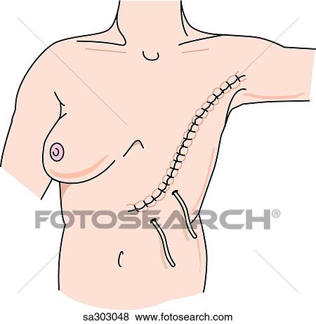 Mastectomy, step 4. View Large Illustration Stock Illustration - Mastectomy, step 4.. Fotosearch