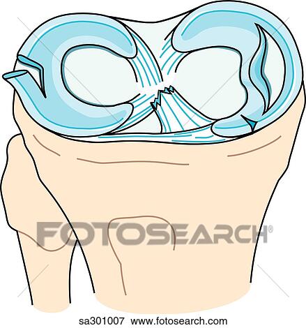 Meniscal tears. View Large Illustration Stock Illustration - Meniscal tears.. Fotosearch