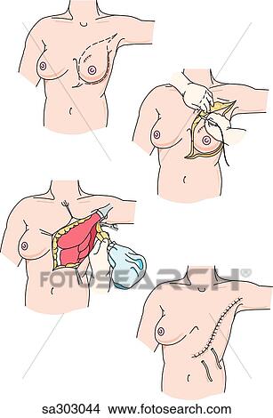 Stock Illustration - Multiple image illustration demonstrating a 4 step operative mastectomy procedure.. Fotosearch