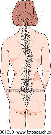 Drawing - Posterior view of female figure with spinal column with lateral curvature of spine as a result of scoliosis.. Fotosearch
