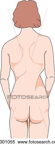 Posterior view of female figure with scoliosis. View Large Illustration Stock Illustration - Posterior view of female figure with scoliosis.. Fotosearch