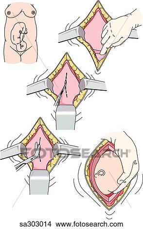 Series of images demonstrating the operative steps of a Cesarian section delivery. View Large Illustration Stock Illustration - Series of images demonstrating the operative steps of a Cesarian section delivery.. Fotosearch