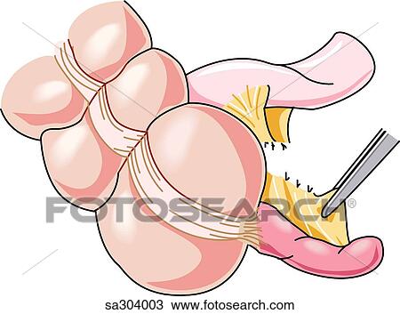 Step 1 in the removal of the appendix. View Large Illustration Drawing - Step 1 in the removal of the appendix.. Fotosearch