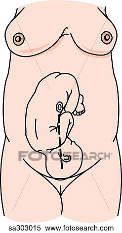 Stock Illustration - Step 1 of a Cesarian section delivery.. Fotosearch