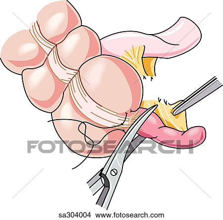 Step 2 in the removal of the appendix. View Large Illustration Stock Illustration - Step 2 in the removal of the appendix.. Fotosearch