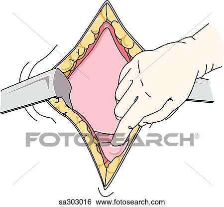 Step 2 of a Cesarian section delivery. View Large Illustration Stock Illustration - Step 2 of a Cesarian section delivery.. Fotosearch
