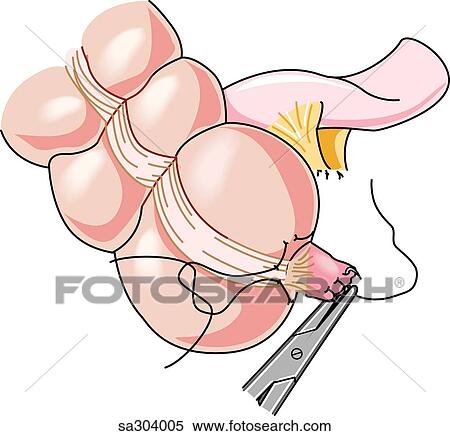 Step 3 in the removal of the appendix. View Large Illustration Stock Illustration - Step 3 in the removal of the appendix.. Fotosearch