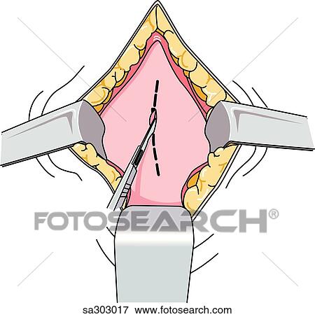 Step 3 of a Cesarian section delivery. View Large Illustration Stock Illustration - Step 3 of a Cesarian section delivery.. Fotosearch