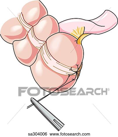 Step 4 in the removal of the appendix. View Large Illustration Stock Illustration - Step 4 in the removal of the appendix.. Fotosearch