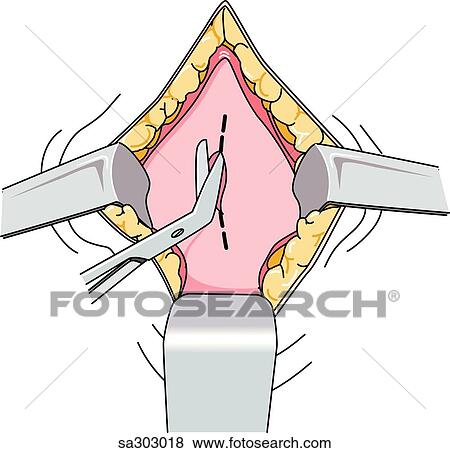 Step 4 of a Cesarian section delivery. View Large Illustration Stock Illustration - Step 4 of a Cesarian section delivery.. Fotosearch