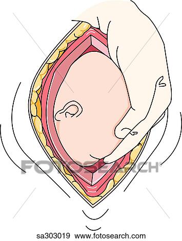 Step 5 of a Cesarian section delivery. View Large Illustration Stock Illustration - Step 5 of a Cesarian section delivery.. Fotosearch