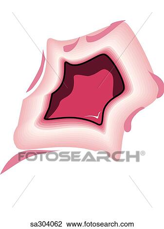 Stomach ulcer. View Large Illustration Drawing - Stomach ulcer.. Fotosearch