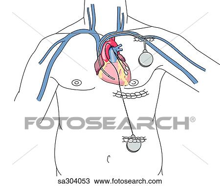 Drawing -  the thorax of an adult male showing two typical locations of pacemakers.. Fotosearch