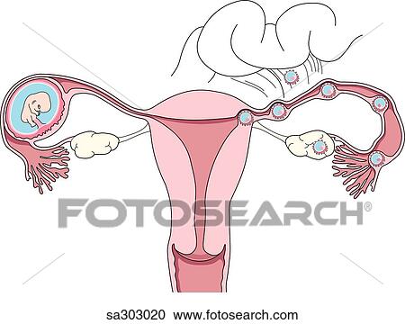 the various possible locations of an ectopic pregnancy within the uterus, ovaries and fallopian tubes. View Large Illustration Clipart - the various possible locations of an ectopic pregnancy within the uterus, ovaries and fallopian tubes.. Fotosearch