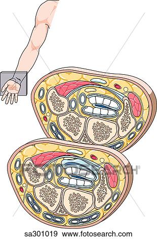 Two cross-sections of the right hand at the level of the wrist to show the anatomy involved in carpal tunnel syndrome. Orientation drawing upper left. View Large Illustration Stock Illustration - Two cross-sections of the right hand at the level of the wrist to show the anatomy involved in carpal tunnel syndrome. Orientation drawing upper left.. Fotosearch