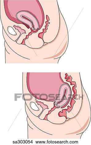 Stock Illustration - Two part illustration showing the more typical anteversion position of the uterus (left) and the less common retroversion position (right).. Fotosearch