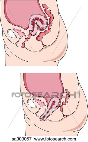 Two part image showing two abnormal positions of the uterus, retroflexion (left) and a prolapsed uterus (right). View Large Illustration Stock Illustration - Two part image showing two abnormal positions of the uterus, retroflexion (left) and a prolapsed uterus (right).. Fotosearch