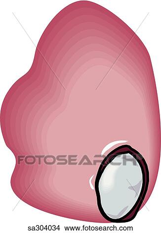 Type of kidney stone. View Large Illustration Stock Illustration - Type of kidney stone.. Fotosearch