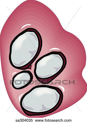 Type of kidney stone. View Large Illustration Stock Illustration - Type of kidney stone.. Fotosearch