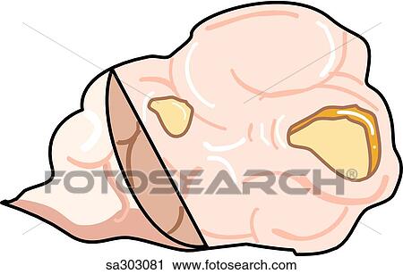 Clip Art - Uterine pathology, type 3.. Fotosearch