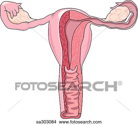 Stock Illustration - Uterine pathology, type 6.. Fotosearch