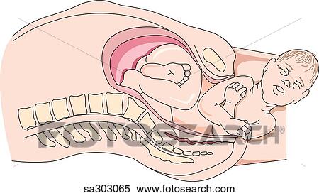 View of full term fetus during later stages of delivery; head and shoulders are outside of the mother. View Large Illustration Stock Illustration - View of full term fetus during later stages of delivery; head and shoulders are outside of the mother.. Fotosearch