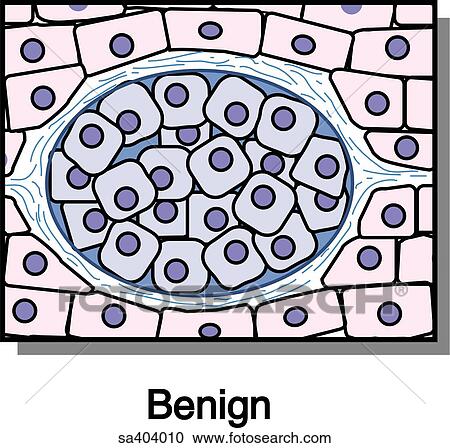 Benign tissue growth. View Large Illustration Clipart - Benign tissue growth.. Fotosearch