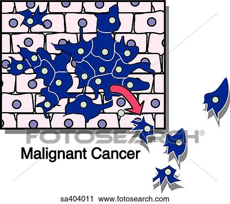 Cancerous tissue growth. View Large Illustration Clip Art - Cancerous tissue growth.. Fotosearch