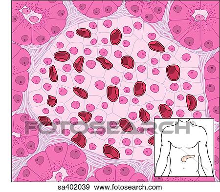Stock Illustration - Close-up of an islet of Langerhans lying in the interstitial tissue of the pancreas. Inset shows location of pancreas.. Fotosearch