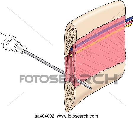 Cross-section of a portion of the ribcage showing the intercostal artery and vein running parallel to the ribs within the intercostal muscles. Needle is penetrating the muscle to gain access to the chest cavity. View Large Illustration Drawing - Cross-section of a portion of the ribcage showing the intercostal artery and vein running parallel to the ribs within the intercostal muscles. Needle is penetrating the muscle to gain access to the chest cavity.. Fotosearch