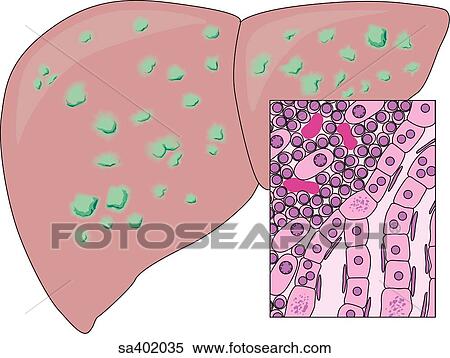 Stock Illustration - External view of liver with visible lesions of hepatitis. Inset shows disease at cellular level.. Fotosearch