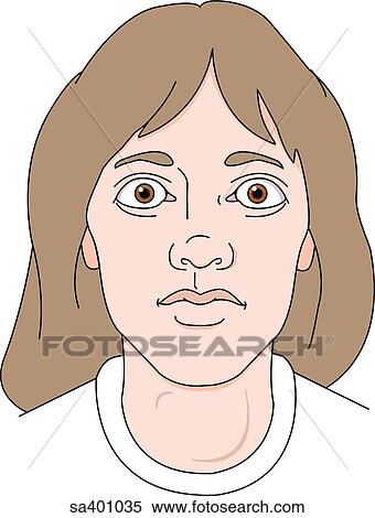 Face of an adult female exhibiting the symtoms of hyperthyroidism. View Large Illustration Stock Illustration - Face of an adult female exhibiting the symtoms of hyperthyroidism.. Fotosearch