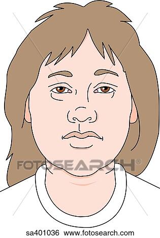 Face of an adult female exhibiting the symtoms of hypothyroidism. View Large Illustration Stock Illustration - Face of an adult female exhibiting the symtoms of hypothyroidism.. Fotosearch