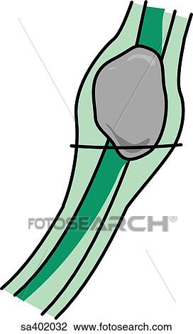 Drawing - Gallstone in the bile duct.. Fotosearch