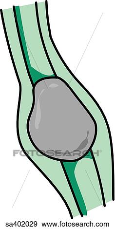 Gallstone in the common hepatic duct. View Large Illustration Stock Illustration - Gallstone in the common hepatic duct.. Fotosearch