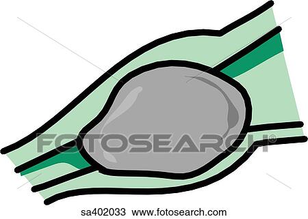 Gallstone in the hepatopancreatic ampulla. View Large Illustration Drawing - Gallstone in the hepatopancreatic ampulla.. Fotosearch