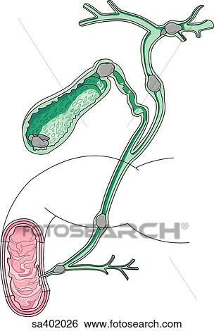 Gallstones of different shapes and sizes located in the gallbladder and bile duct. View Large Illustration Stock Illustration - Gallstones of different shapes and sizes located in the gallbladder and bile duct.. Fotosearch