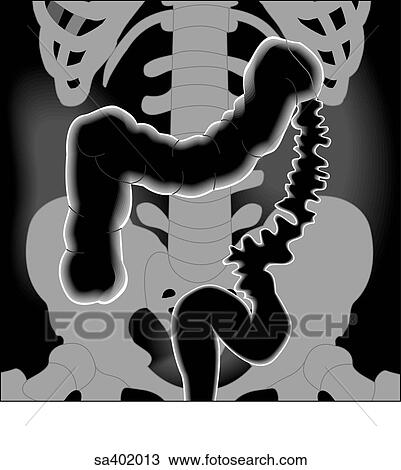 Graphic depiction of highlighted area of the large intestine as seen in a barium x-ray. View Large Illustration Drawing - Graphic depiction of highlighted area of the large intestine as seen in a barium x-ray.. Fotosearch