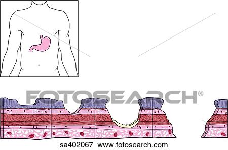 Illustration of layers of the lining of the stomach with ulcers of different severity. Orientation drawing (upper left) shows location of stomach. View Large Illustration Stock Illustration - Illustration of layers of the lining of the stomach with ulcers of different severity. Orientation drawing (upper left) shows location of stomach.. Fotosearch
