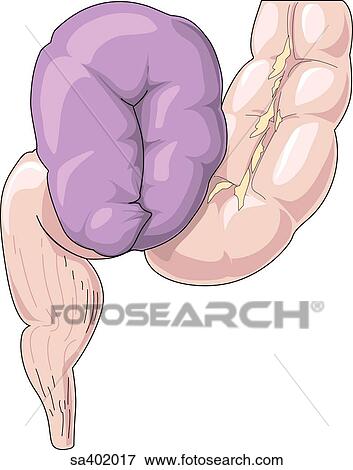 Stock Illustration - Illustration of the twisting of the intestine known as volvulus that results in a bowel obstruction.. Fotosearch