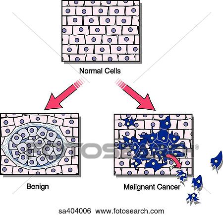 Illustration of tissues at the histological level to show normal (top), benign (lower left), and cancerous (lower right) growth. View Large Illustration Stock Illustration - Illustration of tissues at the histological level to show normal (top), benign (lower left), and cancerous (lower right) growth.. Fotosearch