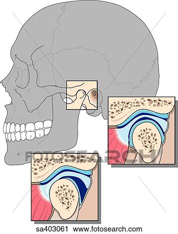 Clip Art - Lateral view of skull featuring temporomandibular joint. Two insets show close-ups of cross-section of synovial joint.. Fotosearch